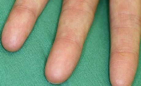 Znanstveniki so odkrili gen, zaradi katerega se ljudje rodijo brez prstnih odtisov.