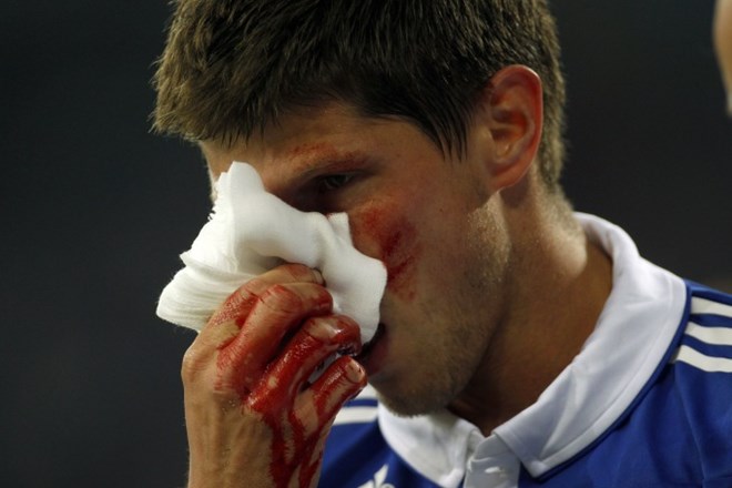 Zdravniške preiskave opravljene po tekmi so pokazale, da ima 26-letni nogometaš zlomljen nos na kar dveh mestih.