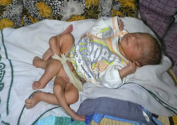 V Pakistanu se je rodil otrok s šestimi nogami.