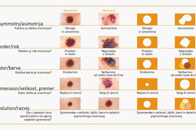 Najboljša metoda za odkrivanje melanoma je metoda ABCDE, ki nas opozarja, na katere spremembe znamenj na koži moramo biti...