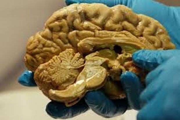 Moškemu, ki trpi za celiakijo, odkrili kamne v možganih