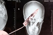 Zdravniki so spregledali, da ima v možganih 10 centimetrov dolgo rezilo