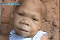 Nenavaden primer 31-letne Brazilke Marie, ki je ujeta v telesu dojenčka