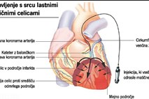 Srčne matične celice so obet za zdravljenje srčnega popuščanja zaradi ishemične bolezni srca