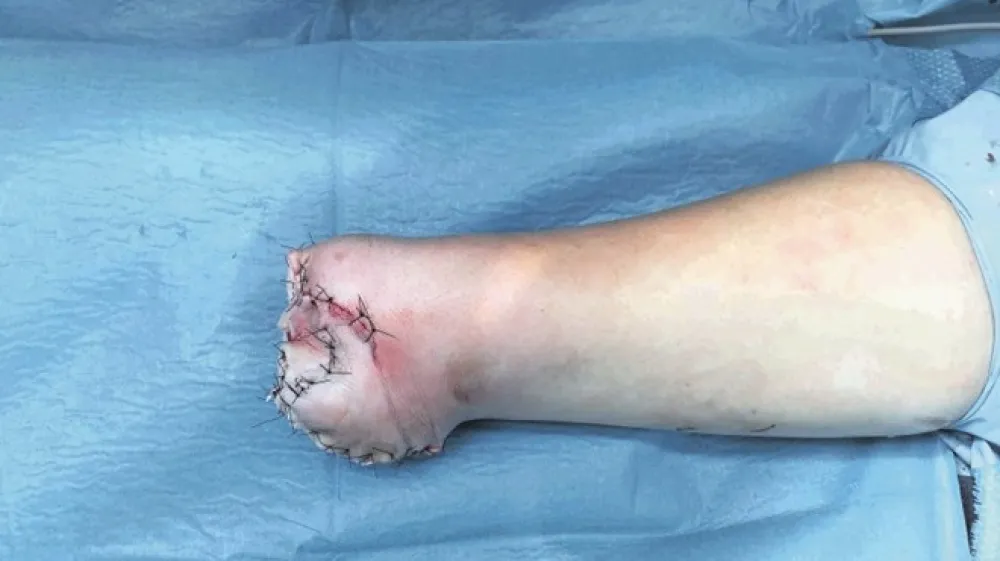 Vsako leto se zaradi uporabe pirotehničnih izdelkov zgodijo dve do tri nesreče, zaradi katerih pride do trajne skaženosti ali celo invalidnosti.