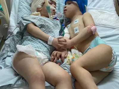 Formerly conjoined twins, Bernardo and Arthur Lima, lie in a hospital bed after a successful separation surgery, in Rio de Janeiro, Brazil July 2022. Gemini Untwined & Instituto Estadual do Cerebro Paulo Niemeyer/Handout via REUTERS  THIS IMAGE HAS BEEN SUPPLIED BY A THIRD PARTY. NO RESALES. NO ARCHIVES. MANDATORY CREDIT