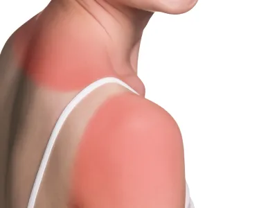 ﻿Sunburn female shoulder isolated on white background