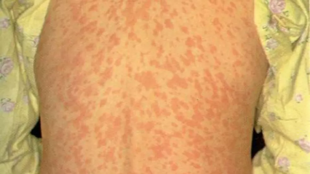 ﻿Nalezljiva bolezen ošpice