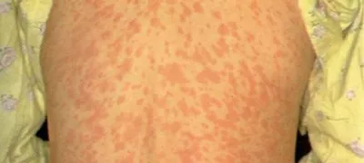 ﻿Nalezljiva bolezen ošpice