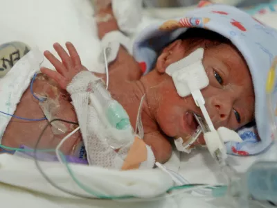 Jerrick De Leon, nedonošenček najmanjši dojenček na svetu tehtal 680 dekagramov