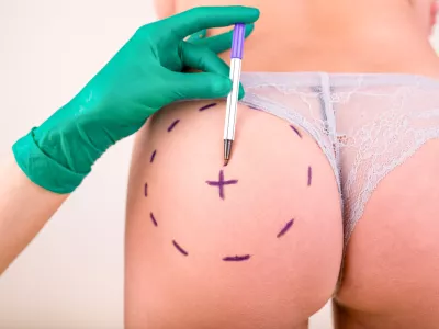 Surgeon drawing marks on female body before plastic operation, white background. Liposuction concept / Foto: Georgiy Datsenko