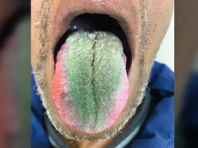 Primer je bil posledica večih dejavnikov, vključno z jemanjem antibiotikov. / Foto: The New England Journal Of Medicine