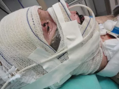 EXCLUSIVE: Story from Jam Press (Steven Johnson Syndrome) Woman left 'burning from inside out' after taking Ibuprofen devastated as doctors say vision is lost for goodA woman who was left 'burning from the inside out' and in a 17-day coma from an extreme reaction to Ibuprofen will never get her sight back, doctors have confirmed.Jaqueline Gmack took the over-the-counter medication to alleviate menstrual cramps, but soon started to experience terrifying symptoms, including blistering skin.The 32-year-old was taken to hospital and put into an induced coma, with doctors discovering her body's reaction to the medication had triggered a rare condition called Stevens-Johnson syndrome (SJS).It was a "miracle" she survived the traumatising incident, but despite 26 operations to save her vision, doctors have recently confirmed the vision in her right eye is lost for good, and vision in her left eye is extremely limited."It has taken a while for the reality to sink in – I entered a period of real mourning," Jaqueline, from Papanduva, Brazil, told NeedToKnow."I don't recognise faces on the street, I can barely see who's next to me."I can't walk alone because I can't see steps, holes, or obstacles."Jaqueline has been suffering corneal perforation – where the cornea, in the front part of the eye, has a hole or opening – since the incident, and has recently had two corneal transplants to prevent her eye from leaking.The issue means she can't regain clear vision, but the first transplant wasn't fully successful, leading to a second in February which involved having her eyelids sewn shut.She said: "I was devastated and overwhelmed because I didn't want my eyelids to be sewn, but I knew it was the only option to save my eye from further corneal damage."A few months on, the stitches eventually fell out, but doctors delivered the devastating news that she will no longer be able to see out of her right eye due to the extensive damage caused by.26 Aug 2025Pictured: WARNING, CONTAINS GRAPHIC CONTENTStory from Jam Press (Steven Johnson Syndrome) Pictured: Jaqueline Gmack in hospital.Woman left 'burning from inside out' after taking Ibuprofen devastated as doctors say vision is lost for goodA woman who was left 'burning from the inside out' and in a 17-day coma from an extreme reaction to Ibuprofen will never get her sight back, doctors have confirmed.Jaqueline Gmack took the over-the-counter medication to alleviate menstrual cramps, but soon started to experience terrifying symptoms, including blistering skin.The 32-year-old was taken to hospital and put into an induced coma, with doctors discovering her body's reaction to the medication had triggered a rare condition called Stevens-Johnson syndrome (SJS).It was a "miracle" she survived the traumatising incident, but despite 26 operations to save her vision, doctors have recently confirmed the vision in her right eye is lost for good, and vision in her left eye is extremely limited.,Image: 1031420443, License: Rights-managed, Restrictions: NO Australia, Germany, Norway, South Korea, Sweden, United Kingdom, United States, Unknown Country, Model Release: no, Pictured: Jaqueline Gmack