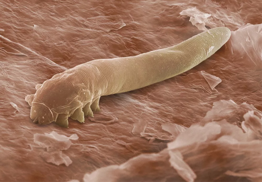 Eyelash mite. Coloured scanning electron micrograph (SEM) of an eyelash, or follicle, mite (Demodex folliculorum), a harmless parasite which lives inside human hair follicles. This mite infests hair follicles (depressions in the skin which contain the roots of hairs) around the eyelids, nose and in the ear canals of humans. It feeds on oily secretions from the skin's sebaceous glands, which empty into the follicles, as well as dead skin cells. Infestation with follicle mites is usually symptomless; they cause no harm to their host. However, allergic reactions to the mites in susceptible individuals can cause hair loss and acne. Magnification: x233 at 6x7cm size.,Image: 103067753, License: Rights-managed, Restrictions:, Model Release: no / Foto: Profimedia