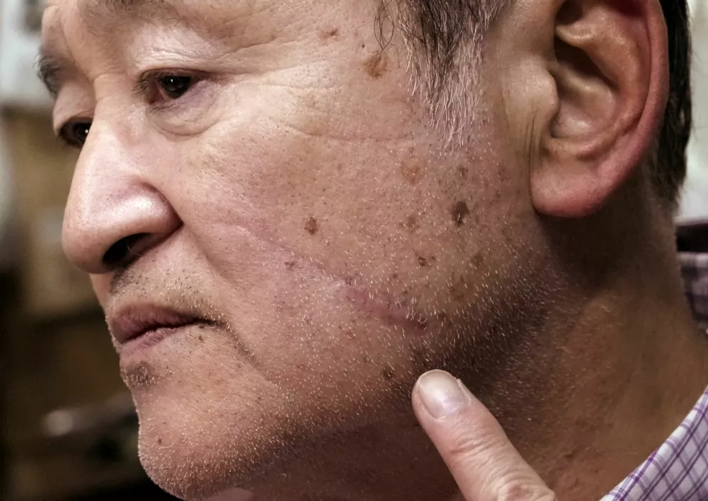 Keiji Minatoya, 68, a confectionery shop owner who was attacked by a black bear in front of the garage in his backyard on October 19, 2023, points to a scar on his face from the attack, during an interview with Reuters in Kitaakita, Akita Prefecture, Japan, November 6, 2025. REUTERS/Tom Bateman