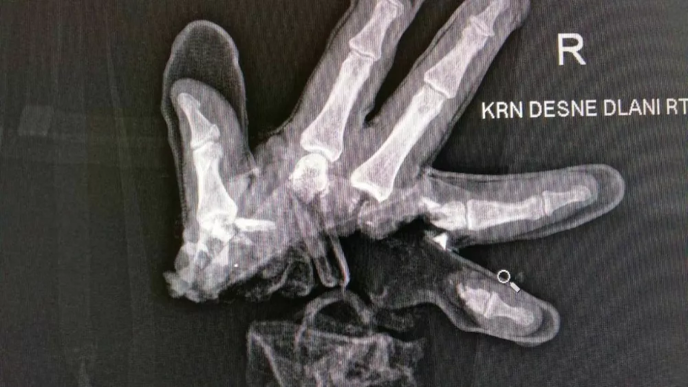 Po&scaron;kodbe pri nesrečah s pirotehniko so lahko zelo hude, po&scaron;kodovani pa lahko posledice nosi do konca življenja. 