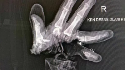 Po&scaron;kodbe pri nesrečah s pirotehniko so lahko zelo hude, po&scaron;kodovani pa lahko posledice nosi do konca življenja. 