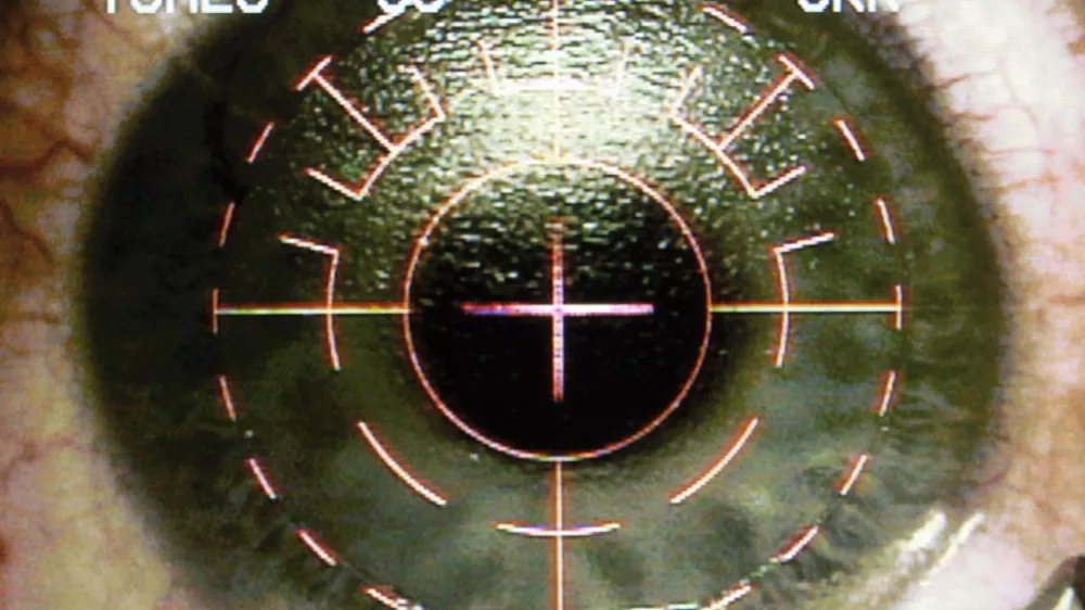 A television monitor shows the image from the operating microscope as Dr. Colman Kraff aligns the center of the pupil and the excimer laser for custom shaping of patient Christopher Tomes' eye during Lasik eye surgery at Kraff's offices in Chicago Nov. 1, 2005. (AP Photo/Charles Rex Arbogast)