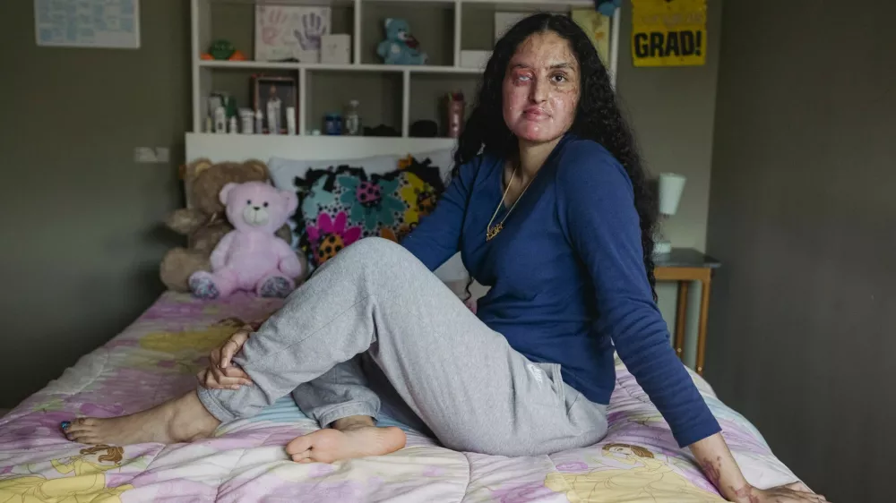 FILE -- Nafiah Ikram, at home in Elmont, N.Y., on April 22, 2021, was severely burned after someone threw acid in her face outside her home. A man was charged with assault on Feb. 10, 2026, five years after the attack.,Image: 1073885068, License: Rights-managed, Restrictions: A MARCH 17, 2021 FILE PHOTO., Model Release: no