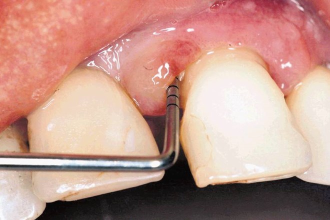 Zobozdravnik bo z zelo preprostim pregledom preveril, kaj se dogaja v vaših ustih. 