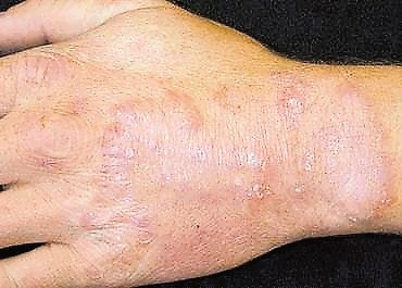 Glivična okužba hrbtišča roke 