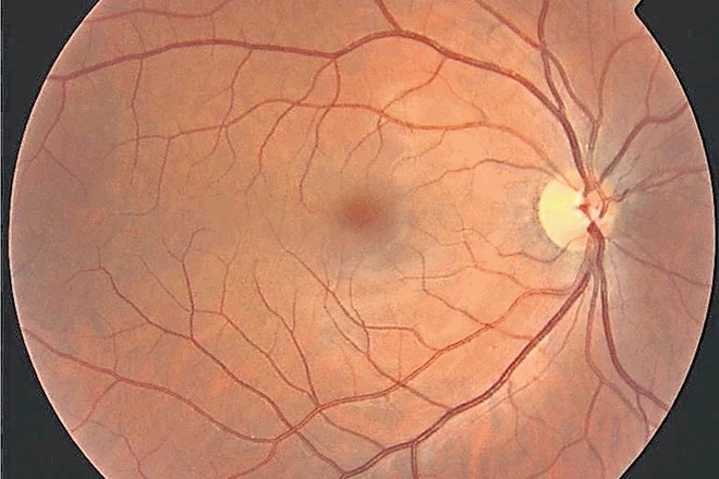 Normalna mrežnica in mrežnica pri diabetični retinopatiji z edemom v rumeni pegi  