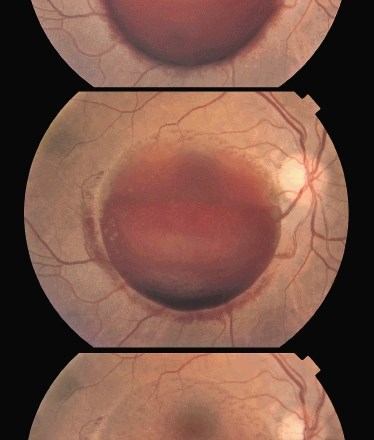 Kategorija: barvna slika očesnega ozadja (prvo mesto); krvavitev pred mrežnico (zgoraj prvi obisk pacientke, srednja slika 14...