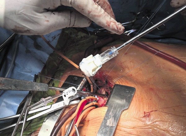Menjava aortne zaklopke z minimalnim pristopom med rebri na desni strani prsnega koša, pri čemer je zunajtelesni krvni obtok...