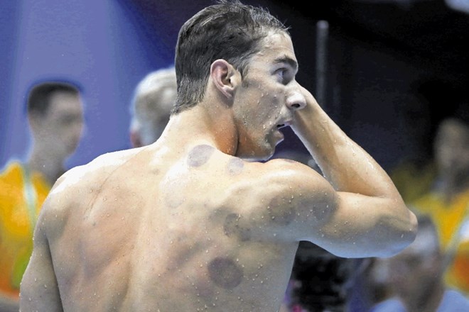 Madeži na hrbtu ameriškega plavalca Michaela Phelpsa so odtisi ventuz, kozarčkov, ki jih uporabljajo v tradicionalni kitajski...