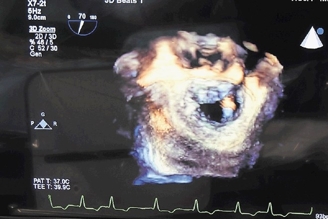 Tridimenzionalna ultrazvočna predstavitev srca med implantacijo zaklopke