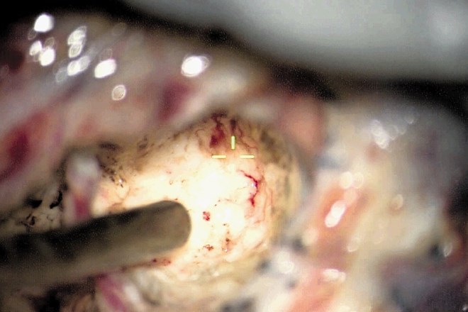 Robotska navigacija projicira nevrokirurgu v okular operacijskega mikroskopa obris tumorja pri dani globini.