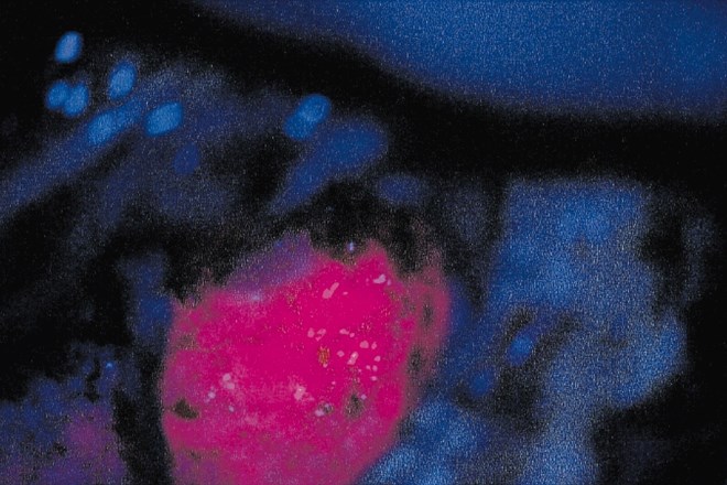 Po osvetlitvi z modro svetlobo je vidna plast tumorja v globini, ki vijolično odseva in jo kirurg zdaj  lahko odstrani.