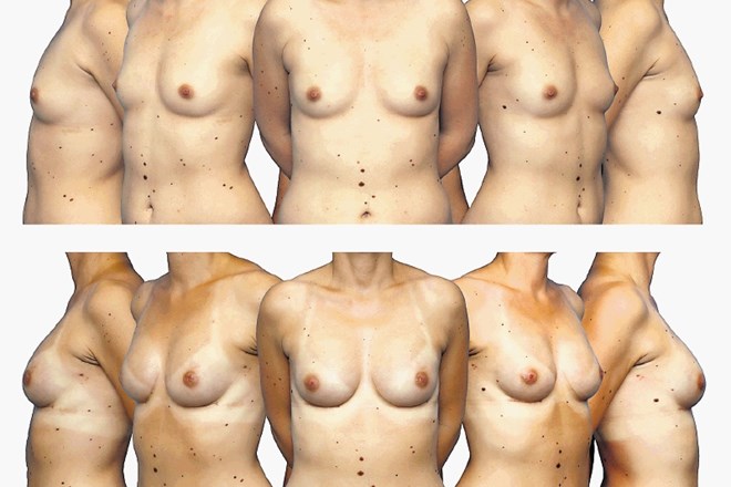 Primer takojšnje obojestranske rekonstrukcije dojke z anatomsko oblikovanima trajnima vsadkoma in podporno mrežico (zgoraj...