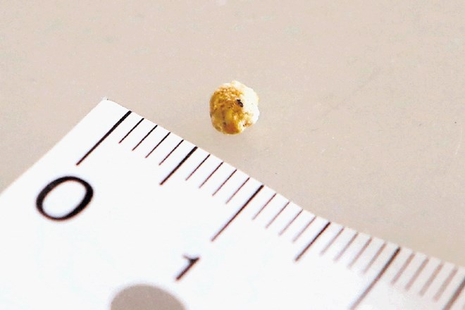 Slinski kamenčki so običajno veliki nekaj milimetrov. Ker pa odtok sline ob kamnih ni vedno moten in bolnik nima veliko...