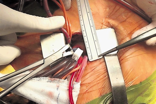 Ljubljanski kardiokirurgi so izmojstrili minimalno invaziven pristop zamenjave aortne zaklopke.