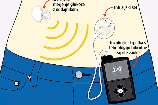 Inzulinska črpalka je elektronska naprava, s pomočjo katere bolnik v telo dovaja inzulin. Te aparature vedno bolj  posnemajo...