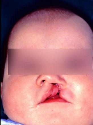 Dojenčica s popolno shizo ustnice, čeljustnega grebena in neba. Po šestih mesecih predoperativne priprave sta se čeljustna...