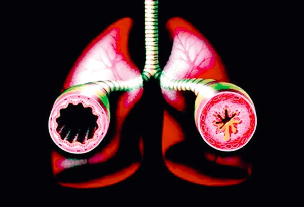 V odrasli dobi je astma še bolj trdoživa