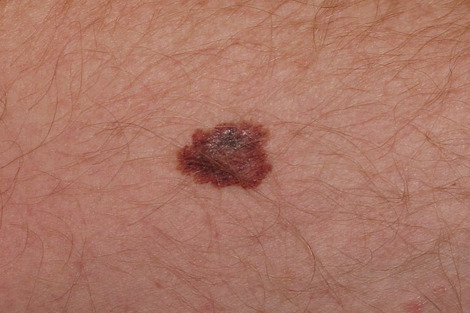 Maligni melanom je ozdravljiv, če je izrezan pravočasno
