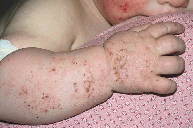 Atopijski dermatitis je najpogostejša in neozdravljiva kožna bolezen, ki lahko prizadene že dojenčke  in potem vse življenje...
