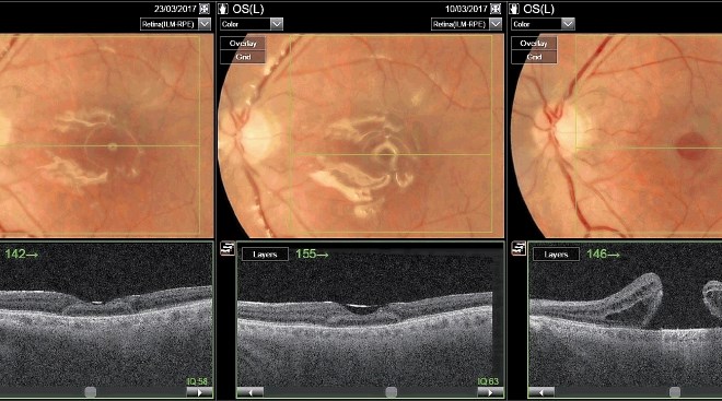 Slike očesnega ozadja (zgoraj) in OCT (spodaj) bolnika po operativnem posegu in pred operativnim posegom (na koncu niza).