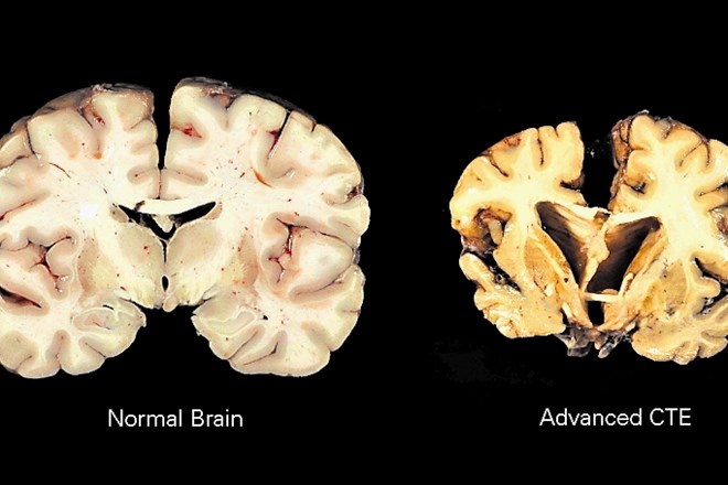 Normalni možgani in možgani, oboleli za CTE