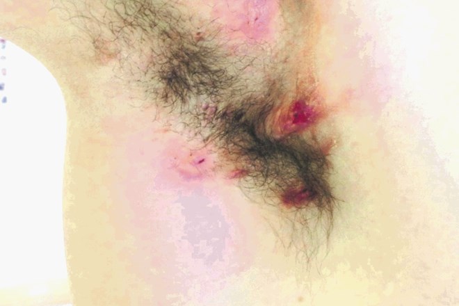 Vnetna bolezen hidradenitis suppurativa II. stopnje na koži pod pazduho.