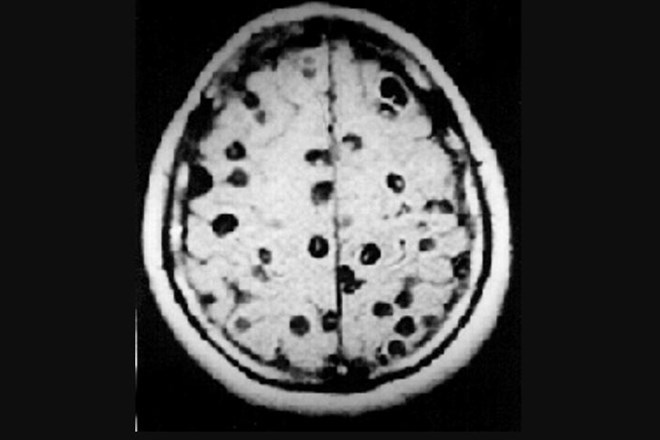 Možgani osebe z nevrocistercirkozo. Vidne so  številne ciste.