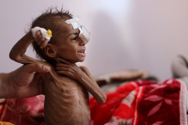 ZN: Polovici mlajših od pet let v Jemnu grozi podhranjenost