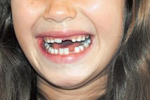 Zobje bolijo tudi otroke s posebnimi potrebami in  otroke, ki jih je   strah zobozdravnikov