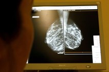 Z genskimi testi bi lahko 70 odstotkom bolnic z najpogostejšim rakom dojk prihranili kemoterapijo 