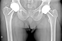 Preplastitvena artroplastika kolka bi lahko ostala odlična izbira za skrbno izbrane paciente