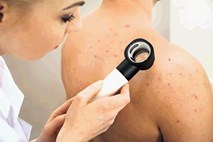 Z napredno tehnologijo do hitrega odkrivanja melanoma