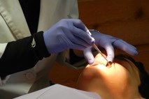 Nemški zobozdravnik izpulil najdaljši zob na svetu
